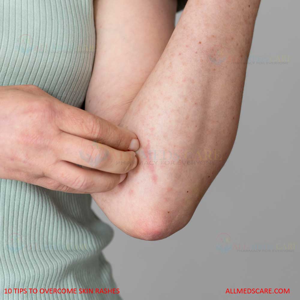10 Amazing Tips to Overcome Skin Rashes, Effective Remedies