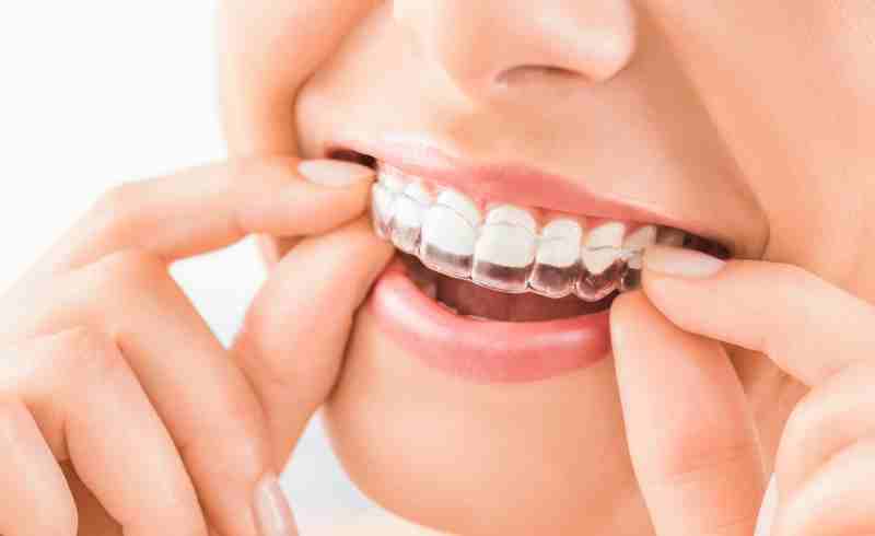 Why Chanhassen Clear Aligners Are the Smart Way to Straighten Your Smile