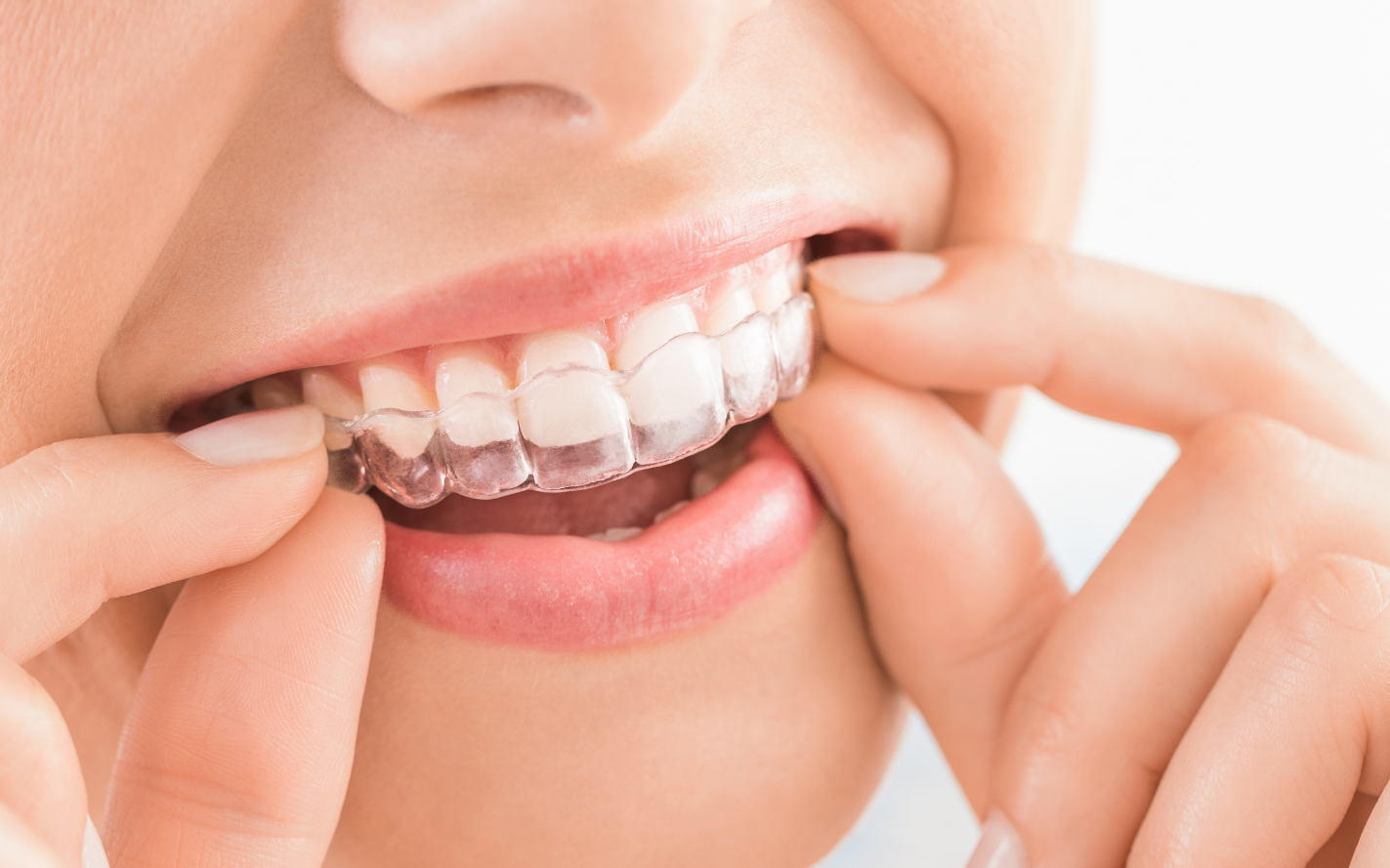 Invisalign in St. Johns & Jacksonville | Clear Aligners Experts | Henry Advanced Orthodontics